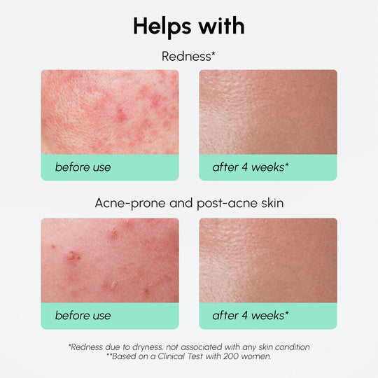 Redness Soothing Azelaic Acid Serum